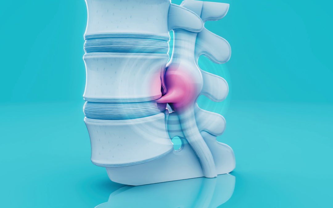 What is Sciatica?